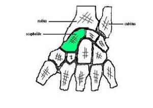 pseudarthrose scaph (1)